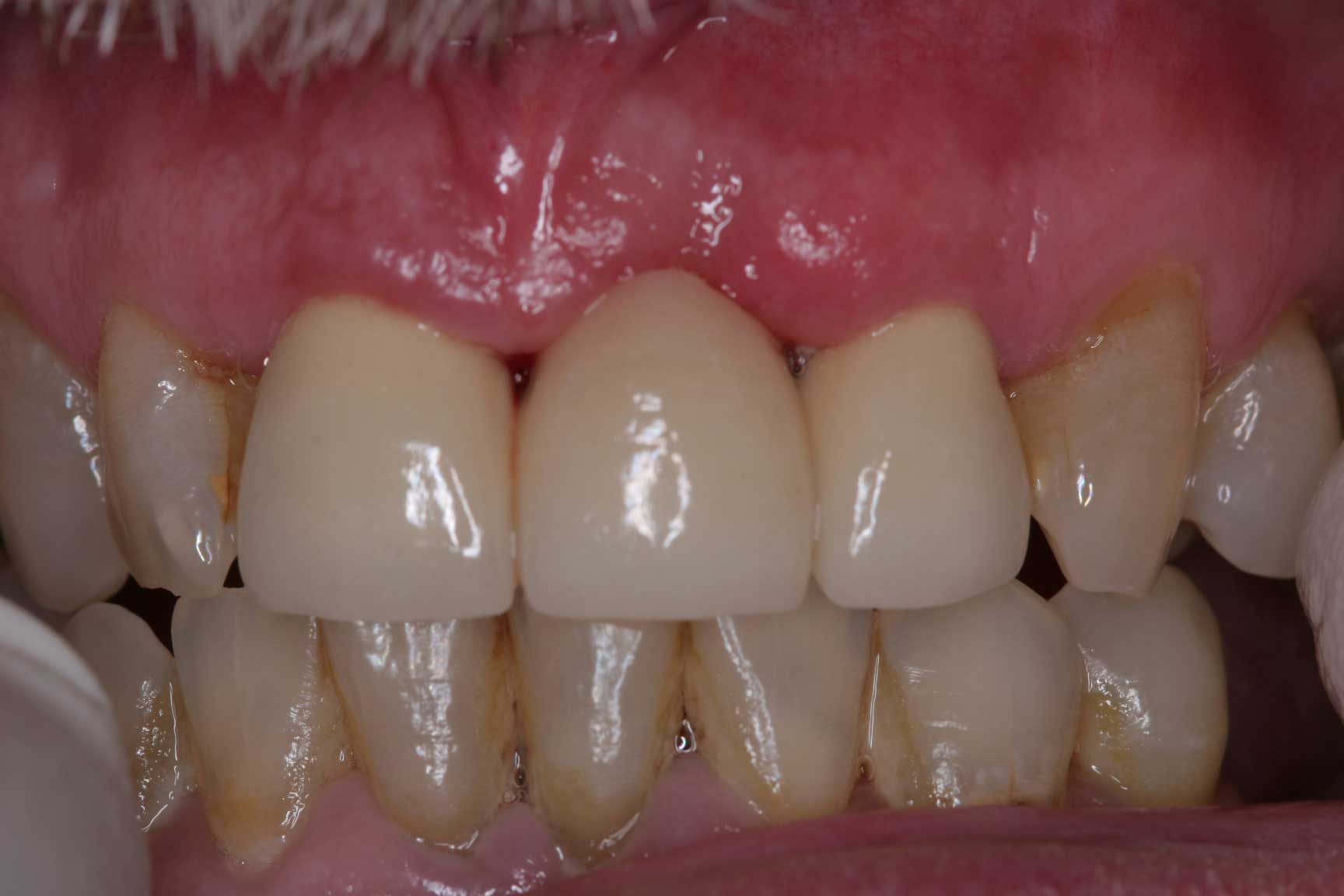 dental accident bridge postop
