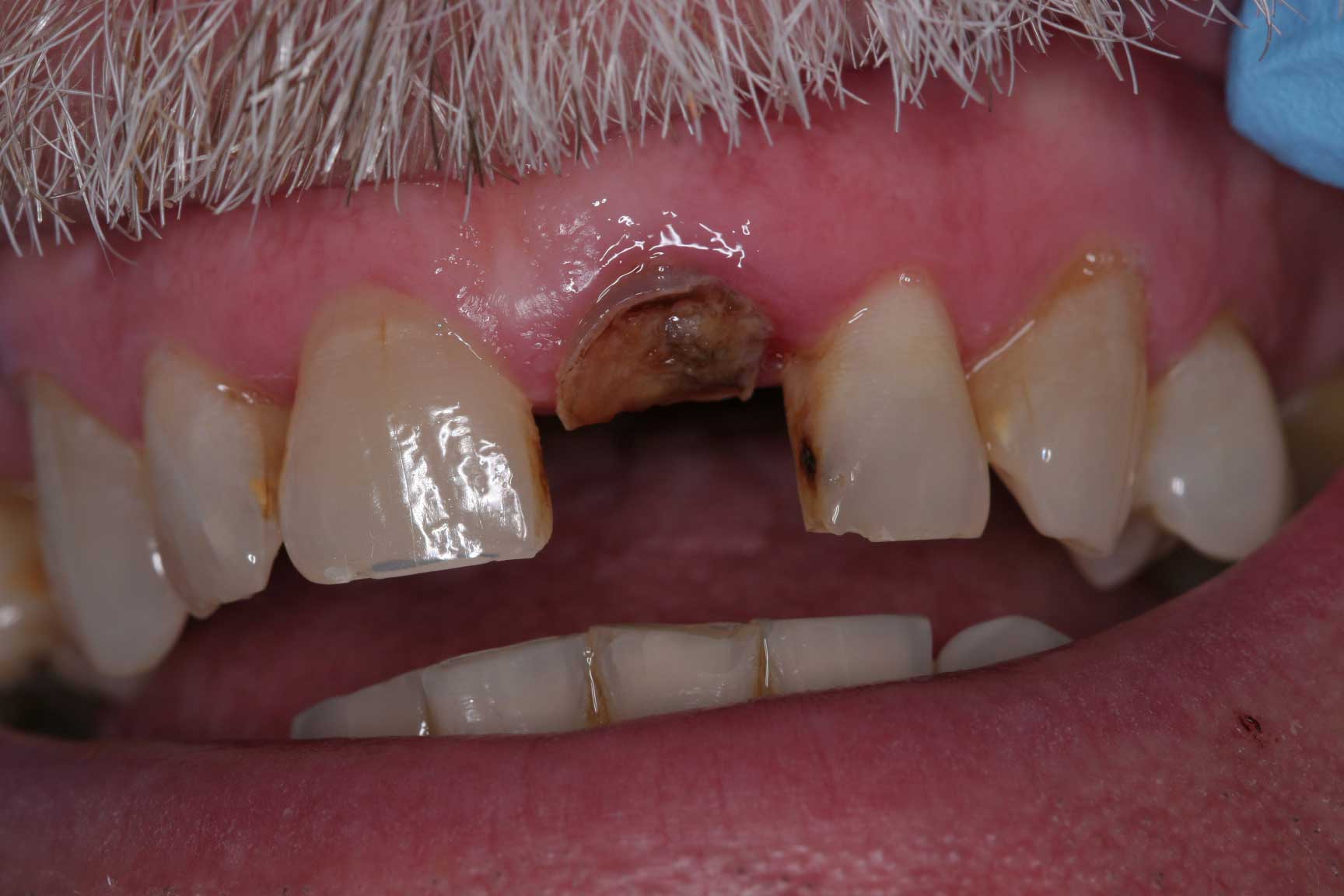 dental accident bridge preop