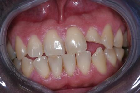 dental accident crown preop