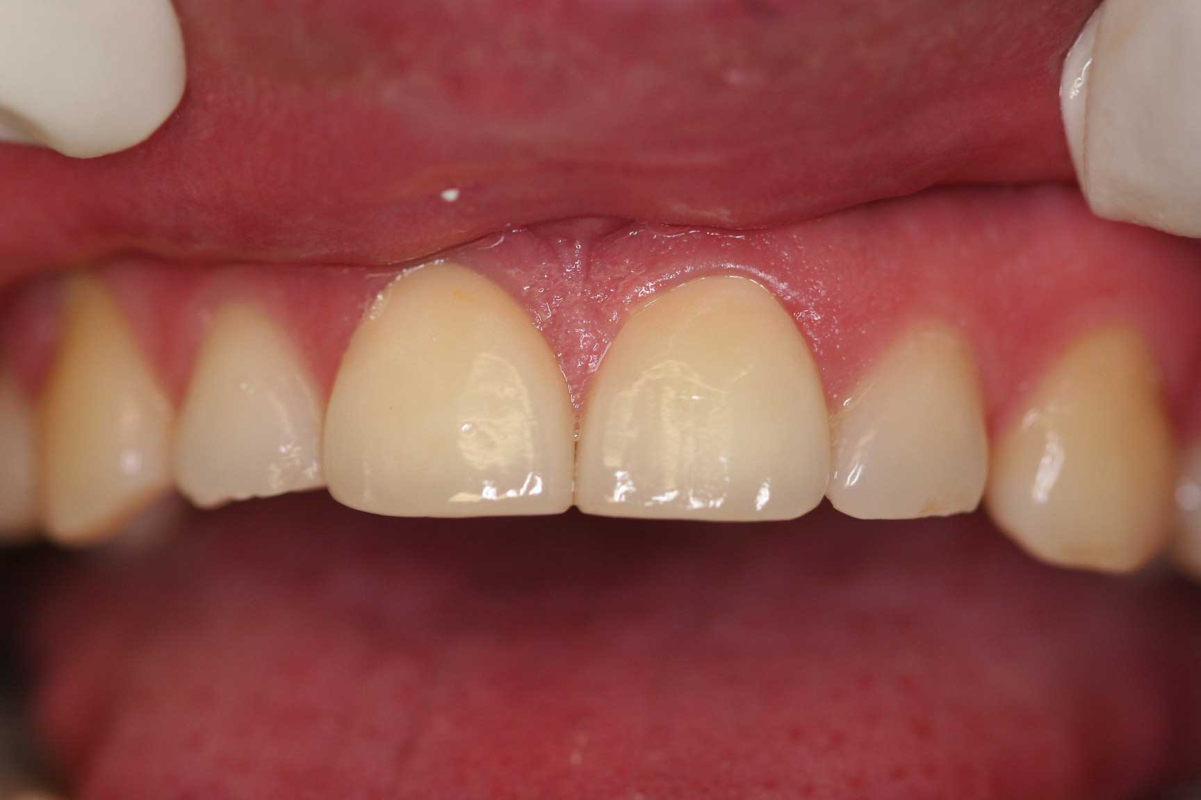 dental accident crown postop