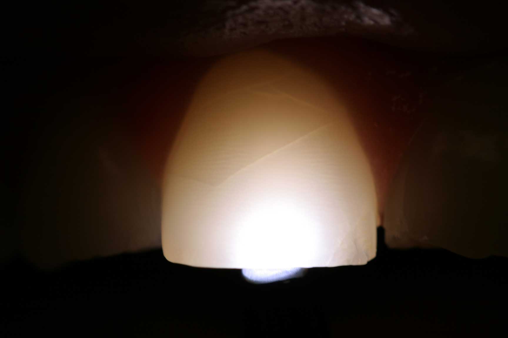 dental accident crown preop