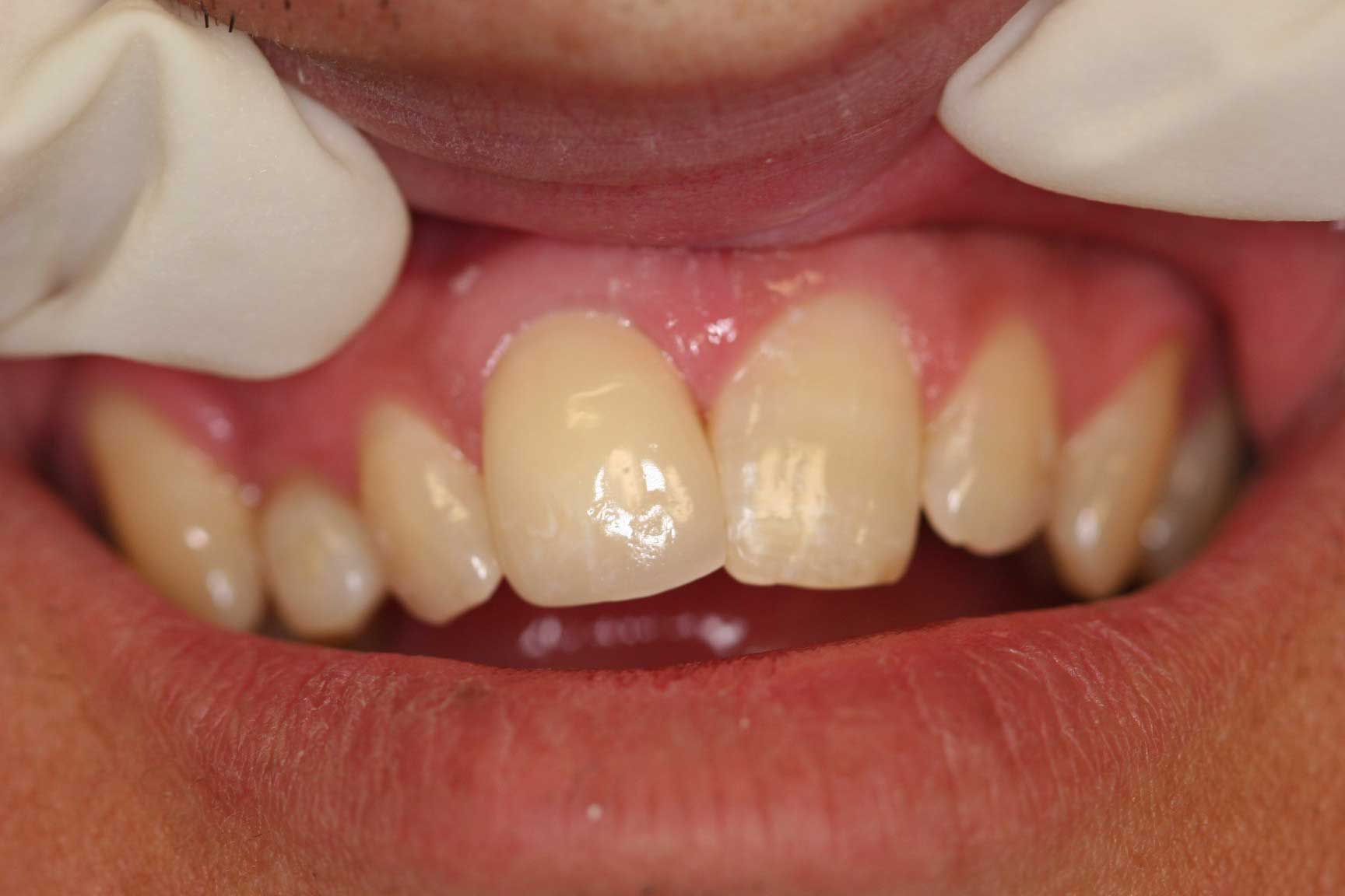 dental accident crown postop