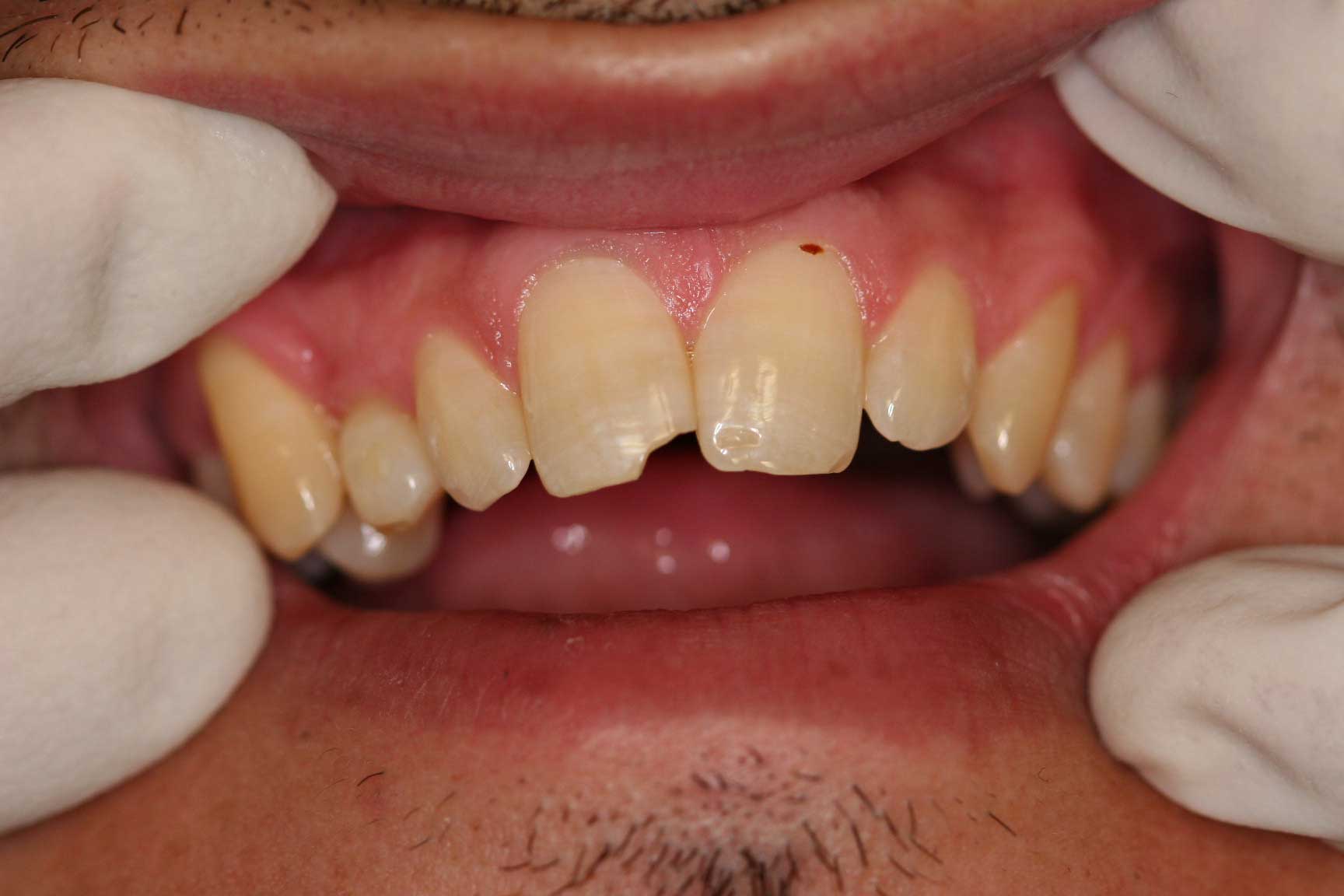 dental accident crown preop