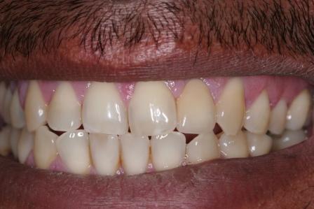 dental accident crown postop